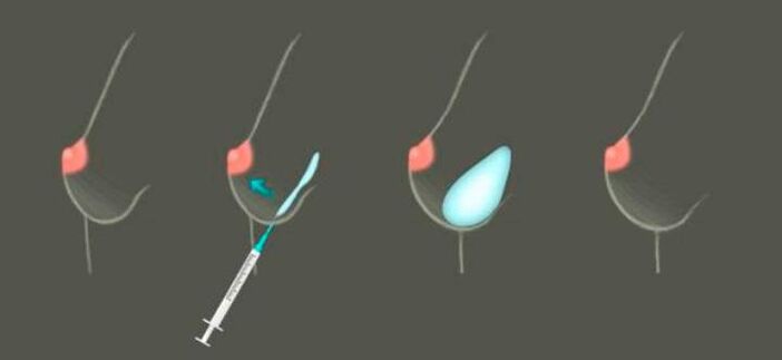 Augmentation mammaire à l'aide d'injections pour hyaluronate la base
