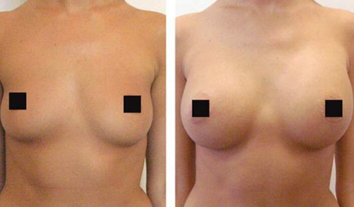 Seins avant et après l'augmentation de l'acide hyaluronique