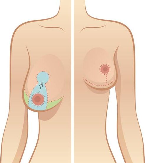 Les seins abandonnés sont une indication de l'entreprise