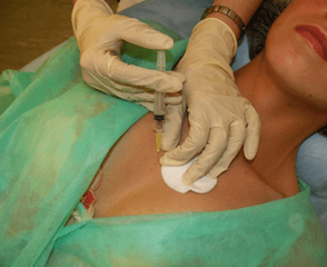 Introduire un méso-cocktail dans le tissu mammaire – une alternative aux injections d’acide hyaluronique