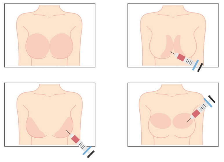 Sites d'injection d'acide hyaluronique dans le sein