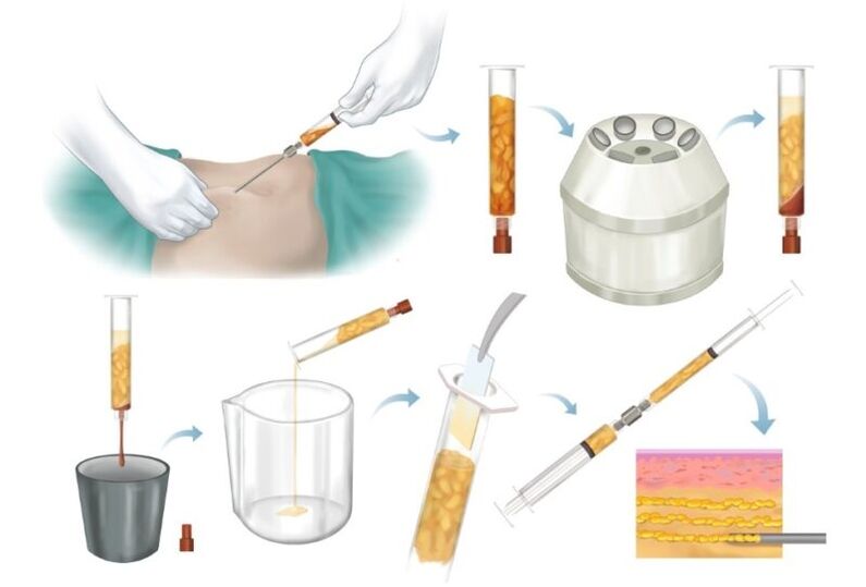 Élimination de la graisse des zones à problèmes, traitement et injection dans le tissu mammaire