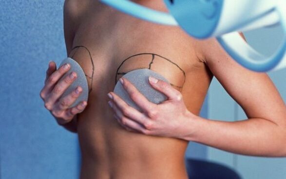 Augmentation mammaire avec implants