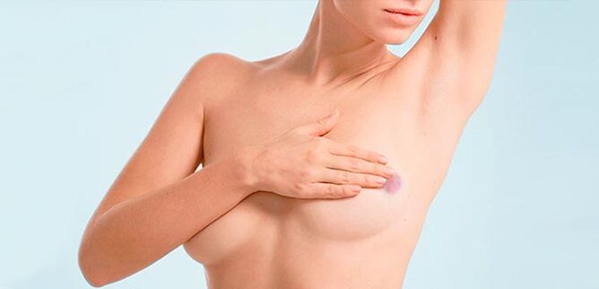 Après une augmentation mammaire avec du hyaluronate, des ecchymoses peuvent survenir au niveau des sites d'injection.