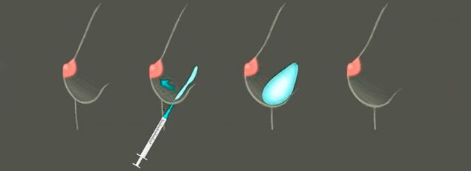 La procédure d'injection d'acide hyaluronique dans le sein