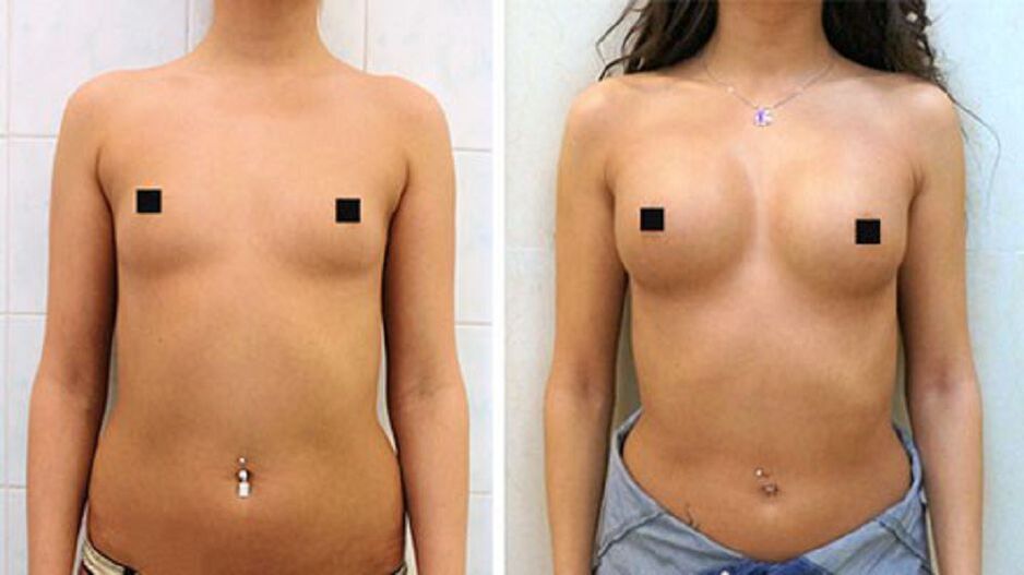 Le résultat d’une augmentation mammaire avec des injections d’acide hyaluronique