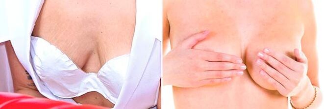 Seins affaissés et asymétriques – indications d’utilisation de l’acide hyaluronique