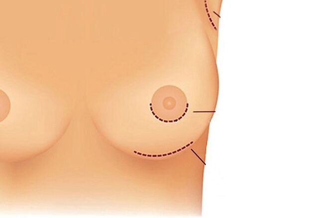 Méthodes d'accès chirurgical à l'augmentation mammaire